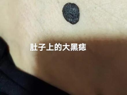 取肚子上大黑痣!#痣的含义 #点痣 #希望能帮到有需要的人 #专业的事交给专业的人 #抖音正能量