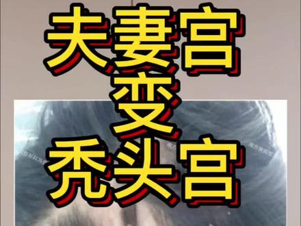 太阳穴填充的典型栓塞病历分享#变美不踩坑 #玻尿酸栓塞 #太阳穴凹陷 #颞部凹陷