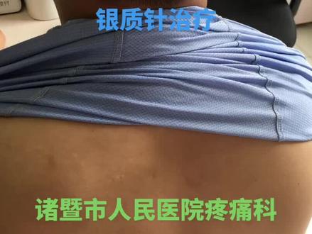 顽固性肌筋膜疼痛,银质针松解是比较有效的治疗手段。疼痛科的微创治疗之一。