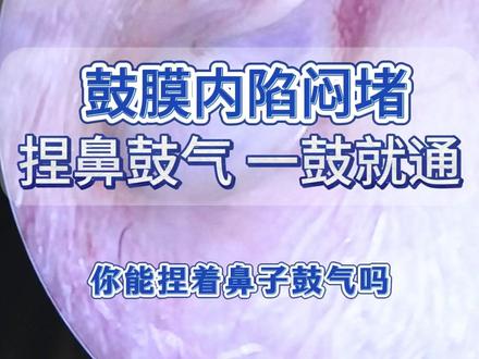 鼓膜内陷闷堵,捏鼻鼓气一股就通 #刘玉和 #鼓膜内陷 #闷堵 #鼓膜
