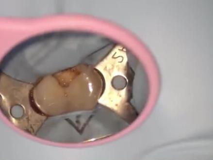 来看看急性牙髓是如何治疗的吧#口腔健康 #保护牙齿 #牙齿