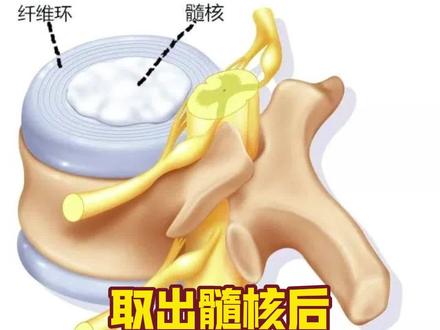 取出髓核后对生活影响有多大
