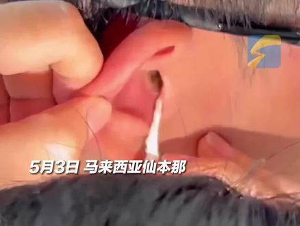 5月3日,马来西亚仙本那,男子国外潜水遭小螃蟹爬进耳朵,医院排队4小时无医生处理,最后朋友用手电筒照着才慢慢爬出。当事人:“有点像采耳,还挺舒服。”