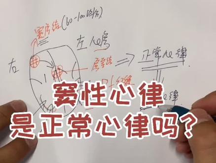 #窦性心律 #心电图 窦性心律是正常心律吗?