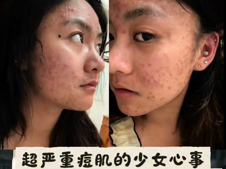 比起大家说的五官好看,我好像更想要一个正常的皮肤#真正的少女心事 #青春蜕变 #如何拯救痘痘肌 #痘肌逆袭