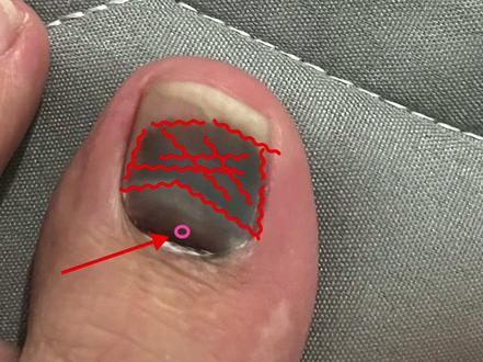 #甲淤血不是灰指甲 #甲淤血处理 #欢迎投稿,。欢迎投稿,如果不处理会怎么样?下期说!