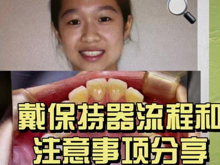 准备摘牙套的,都来看看这个视频 #牙套#整牙#保持器#摘牙套#戴保持器