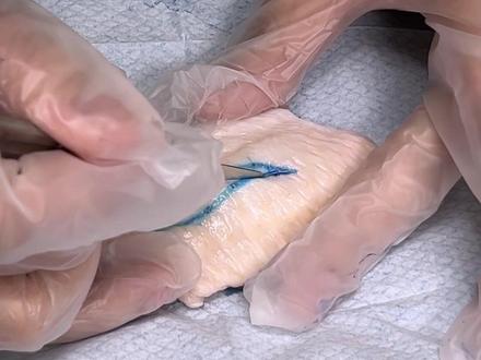 全切双眼皮手术过程演示#双眼皮 #双眼皮手术 #眼整形 #全切双眼皮 #医美