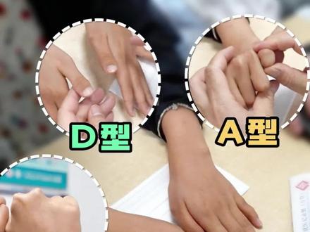 【短指症】A型、D型、E型多种类型合并 #短指 #短指症 #医学科普 #上海六院康庆林