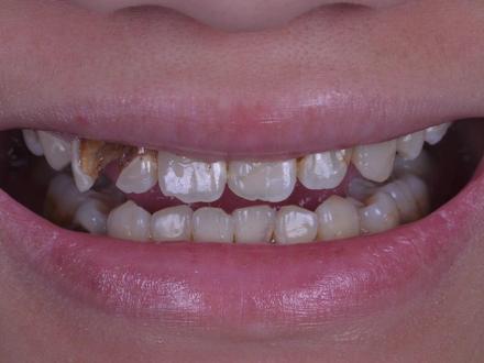 16岁的花季少女,一口烂牙,我们该如何拯救呢?!