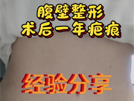 做完腹壁整形术后一年了,给大家看一下我现在的疤痕状况,总结了一下这一年多以来的小经验分享给姐妹们!#腹壁成型 #腹壁整形术 #腹壁疤痕 #腹壁术后 #疤痕