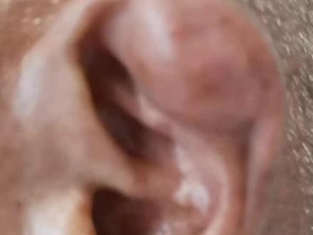 耳廓隆起-耳廓假囊肿#耳朵 #耳廓假性囊肿 #耳廓操