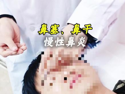 鼻干、鼻塞、慢性鼻炎#鼻干#鼻塞#慢性鼻炎