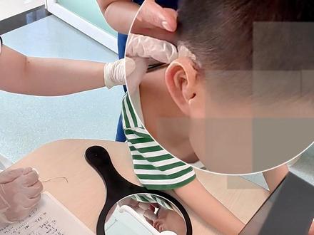 耳再造,做完二期3个月的样子,经过第三期手术后,更完美#耳再造 #孩子的快乐很简单 #孩子 #耳 #诊室日常