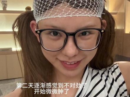 我宣布高炉顶就是细软塌的神#变美逆袭 #高颅顶 #骨水泥 #扁头