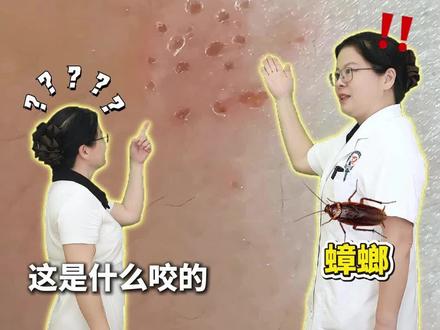 不同虫子咬的伤口,一条视频教你快速区别!
#健康知识科普 #虫咬反应 #虫咬皮炎 #科学育儿科普 #医生科普答疑