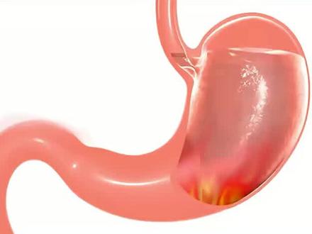 胃气上逆 反酸烧心 清理胃火是关键 #反酸烧心 #胃痛胃胀