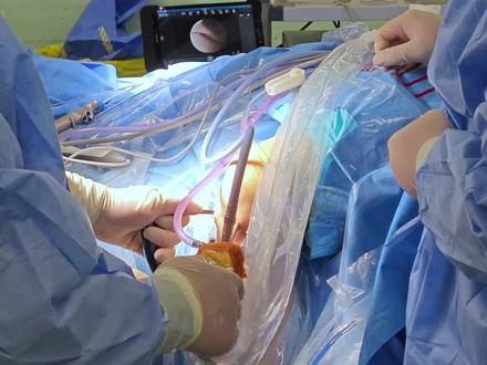 膝关节韧带损伤,微创关节镜手术进行中。#微创手术 #膝关节 #骨科 #韧带重建 #健康守护计划