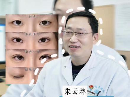 偷偷告诉你埋线双眼皮,有哪些风险你不知道的? #眼整形朱云琳 #双眼皮 #湖州双眼皮 #埋线 #埋线双眼皮