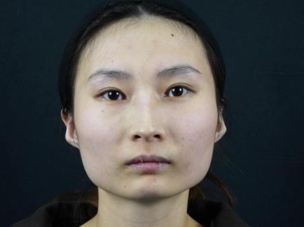29岁河南方脸女孩,术后2个月恢复情况 #方脸 #磨骨 #下颌角 #磨骨三件套 #黄大勇