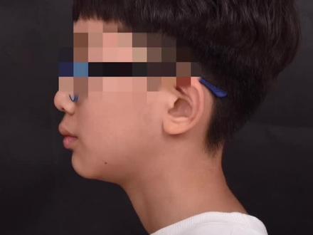 Twin-block 早期矫正.. 侧颜