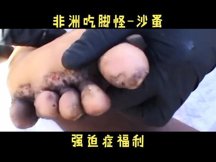非洲吃脚怪-沙蚤 #强迫症 #一般人不知道是什么