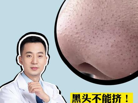 鼻子上的黑头,千万不要乱挤,小心细菌感染!试试这个方法#壬二酸#黑头#科普 #皮肤