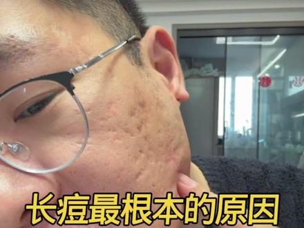 出油多真的容易长痘家人们#长痘 #痘痘
