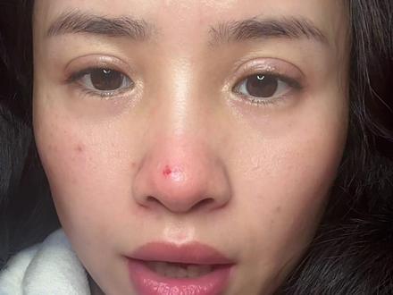 你的双眼皮修复成功了吗#双眼皮 #双眼皮手术 #双眼皮修复 #双眼皮修复