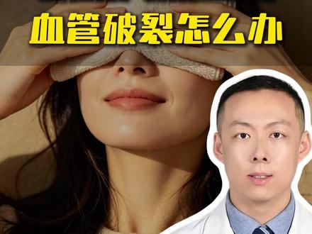 孙俪结膜下血管破裂,是什么原因?大家也要多注意防护 #结膜下出血 #孙俪眼睛血管破裂 #医生解读孙俪眼睛血管破裂 #眼科医生胡亚光 #眼睛科普