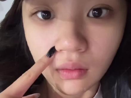 浅浅的记录下do鼻灰复过程#缩鼻翼 #变美 #vlog