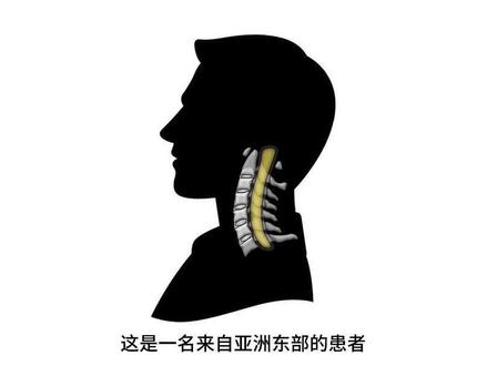中国技术 全球领跑颈椎前路可控前移技术 #颈椎病 #后纵韧带骨化症 #孙璟川长征acaf #微创 #上海长征医院浦东院区