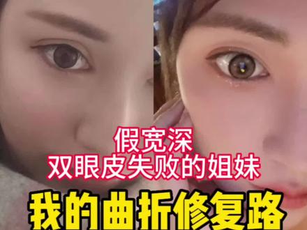 双眼皮失败后,肉条感很重,像虫子一样,几年了别人还问我是不是还没消肿,花了很多年的时间很多精力去修复好,幸而最后成功上岸,今天就分享一下我的经历,希望姐妹们引以为鉴#变美那些事 #双眼皮 #双眼皮修复 #眼睛修复的第三天 #眼修复