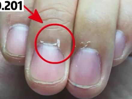 手指长倒刺,千万别乱撕!容易引起皮肤病,教你三步轻松解决#手指 #倒刺 #皮肤