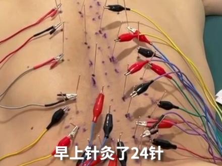 扎过的针装满5升水桶!石智勇带500支针灸针到巴黎:拼过不后悔,我依然为自己骄傲!