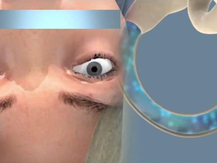 #耳石症复位 这几期视频, 有#耳石症 的朋友都可以收藏下来,好好看看#医学科普 #眩晕 #健康守护计划