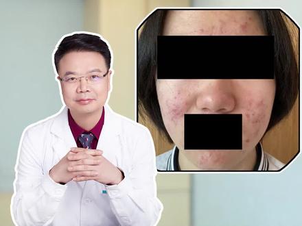 听说吃这个药治痘反而爆痘!#皮肤科医生谢红付 #dou来说健康 #红付教授说敏痘