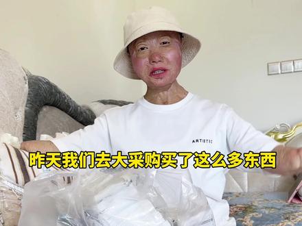 烧伤就是不死的“癌症”,多亏了我的家人