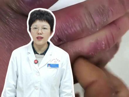 冬天冻疮发作,又痒又痛!教你如何缓解!#冻疮 #冻疮的苦恼 #冻疮的手 #科普涨知识 #生活小妙招