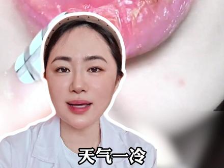 你可能得了唇炎,只是自己还不知道#唇炎 #医学科普 #抖出健康知识宝藏