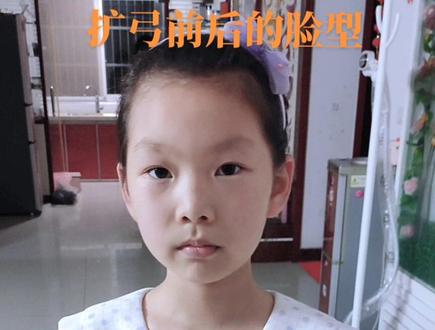 家人们带扩弓器前后的脸型有变化吗?上牙扩了7mm时,让停下来了#整牙历程 #扩弓矫正 #牙套女孩