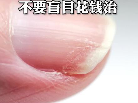 指甲长竖纹、易脆,记得捂紧钱包,不要撕它!#医学科普 #手指甲 #涨知识