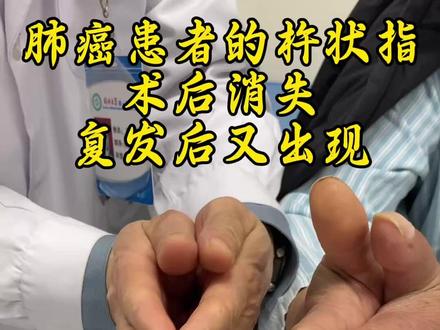 杵状指消失了,肺癌复发又来了#肺癌 #杵状指