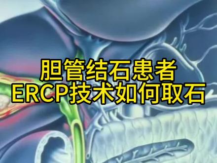胆管结石患者,ERCP技术如何取石#胆管结石 #医学科普 #ERCP #健康科普