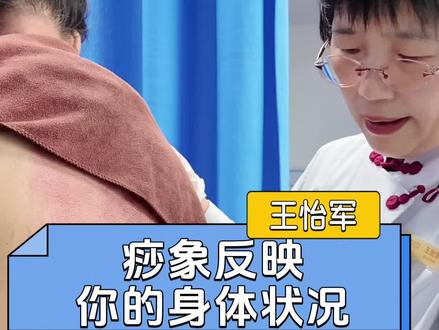 痧象反映你的身体情况 #王怡军#刮痧#抖出健康知识宝藏