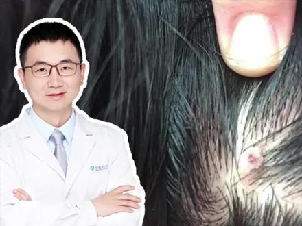 头皮脓包长#痘痘 ?碰到#头皮毛囊炎 应这样治疗!#皮肤病 #头皮护理 #健康科普