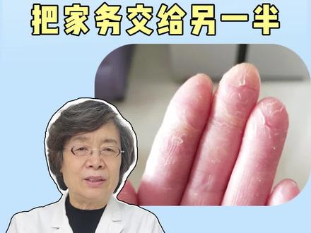 女性手指开裂起皮,家务活就让另一半帮你做吧!#医学科普 #皮肤 #夫妻 #角化型湿疹 #肝素钠乳膏