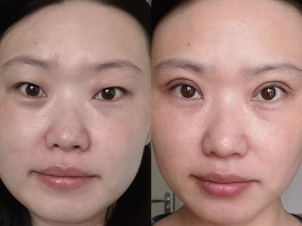 双眼皮术后10天效果大反馈!#全切双眼皮 #肿眼泡 #肿眼泡变双眼皮#北京双眼皮