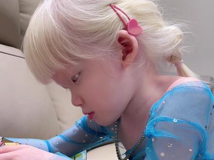 小小人儿什么都懂~#月亮的孩子 #白化病宝贝