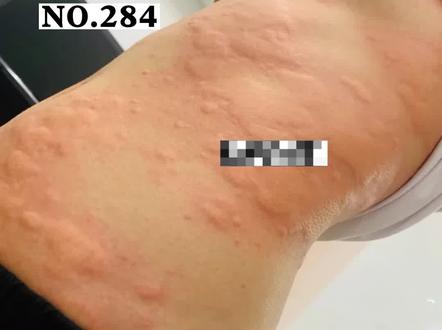 一到晚上就起风团,痒得睡不着,白天有消退,可能是#急性荨麻疹 ,医生教你怎么做#荨麻疹 #医学科普